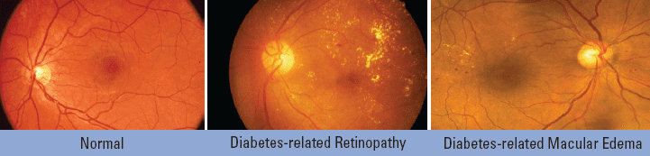 Normal eyes, eyes with diabete-related retinopathy, and eyes with diabetes-related macular edema