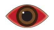 uveitis symptoms - red eyes