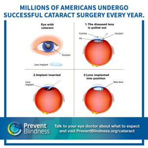 Millions of Americans Undergo Successful Cataract Surgery Every Year