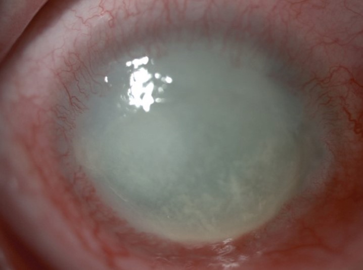 Parasitic (Acanthamoeba) infection - closeup of the eye