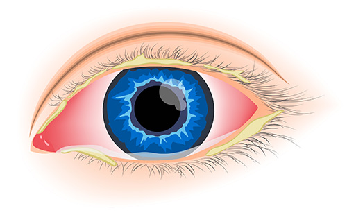 An illustration of an eye showing typical symptoms of bacterial conjunctivitis (bacterial pink eye) including redness.