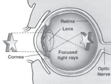 Light passes through a normal eye without anything blocking its way is different from an eye cataract. A cataract is a clouding of the lens that blocks light passing through it.