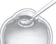 Phacoemulsification procedure during cataract surgery