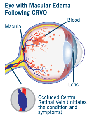 Diagram displaying an eye with CRVO