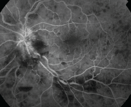fluorescein angiography