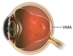 Diagram displaying what an eye with VMA looks like