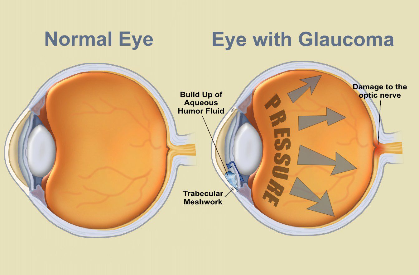 Diagram of a normal eye compared to an eye with glaucoma