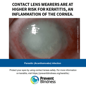 Contact lens wearers are at higher risk for keratitis, an inflammation of the cornea.