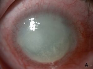 microbial keratitis