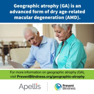 Geographic Atrophy (GA) is an advanced form of dry age-related macular degeneration (AMD).