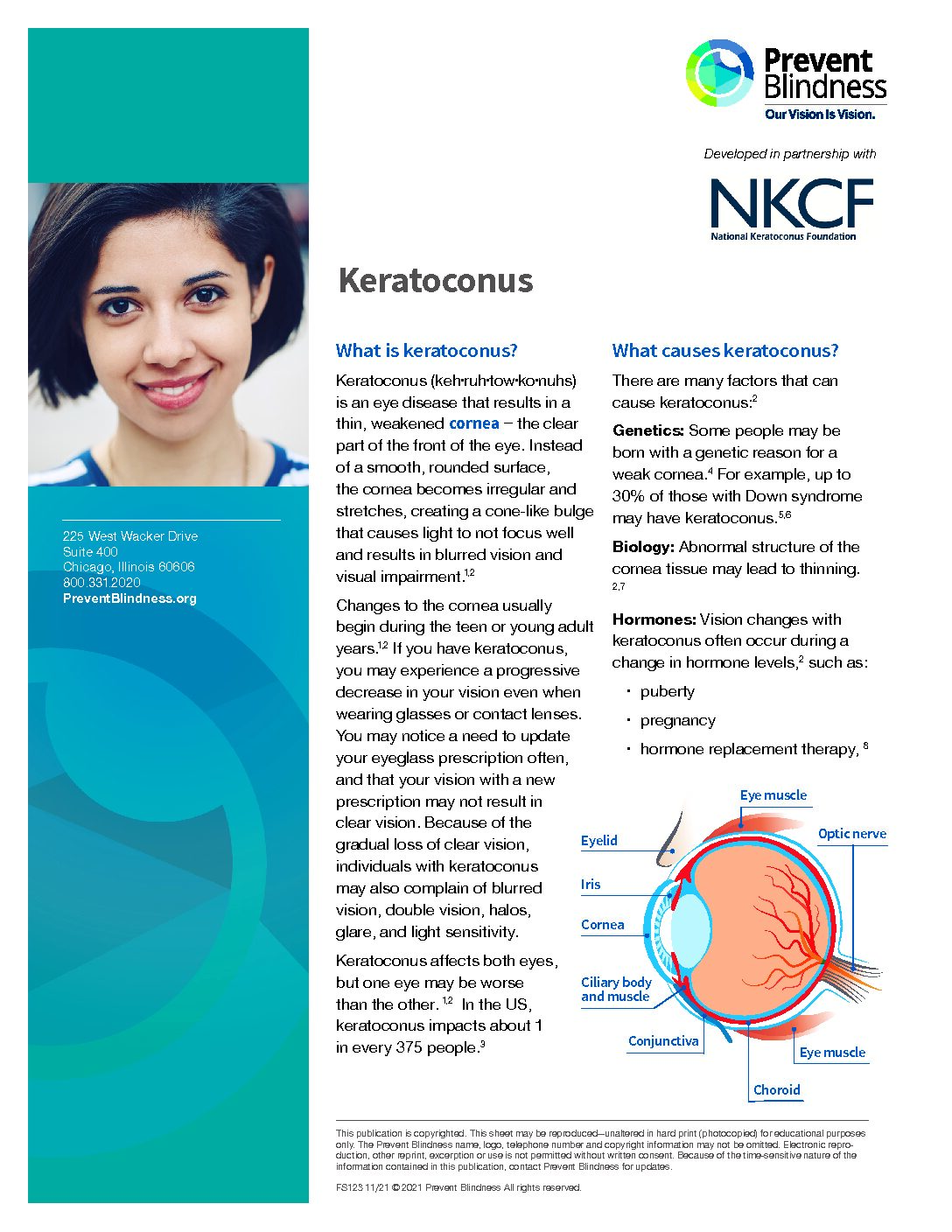 Keratoconus