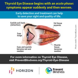 Thyroid Eye Disease begins with an acute phase: symptoms appear suddenly and then worsen.