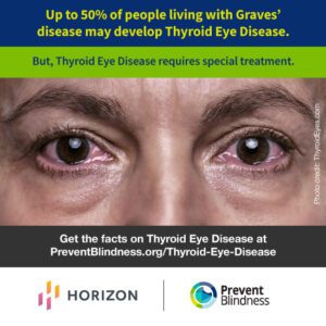 Up to 50% of people living with Graves' disease may develop Thyroid Eye Disease
