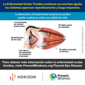 La Enfermedad Ocular Tiroidea 1