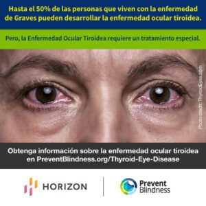 Hasta el 50% de las personas que viven con la enfermedad de Graves pueden desarrollar la enfermedad ocular tiroidea