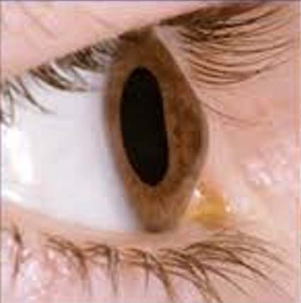 keratoconic cornea