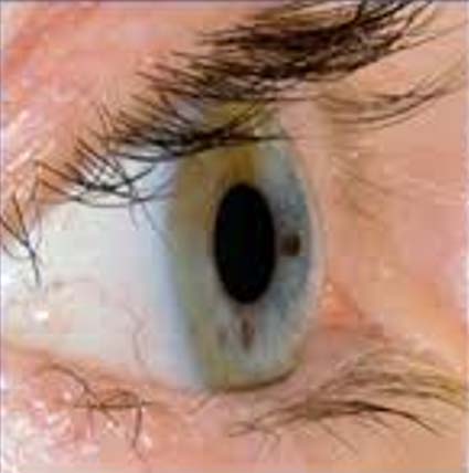 a normal cornea