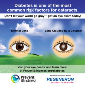 Diabetes is one of the most common risk factors for cataracts