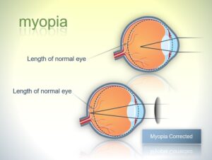 Healthy Eyes Module 2, Refractive Error - Myopia