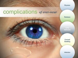 Healthy Eyes Module 3, Contact Lenses