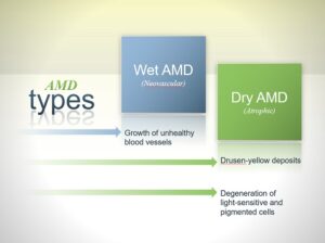 Healthy Eyes module 4, types of AMD