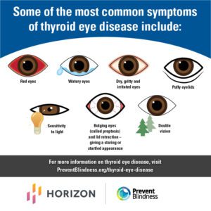 thyroid eye disease infographic