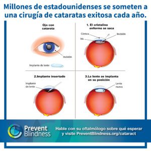 Millones de estadounidenses se someten a una cirugía de cataratas exitosa cada año. Hable con su oftalmólogo sobre qué esperar y visite PreventBlindness.org/cataract