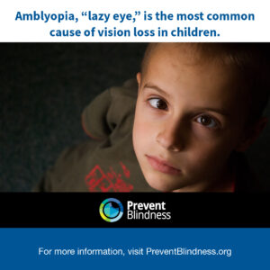 Amblopyia (lazy eye) is the most common cause of vision loss in children.