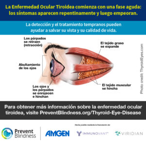 La Enfermedad Ocular Tiroidea comienza con una fase aguda: los síntomas aparecen repentinamente y luego empeoran.