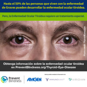 Hasta el 50% de las personas que viven con la enfermedad de Graves pueden desarrollar la enfermedad ocular tiroidea.