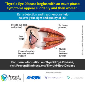 Thyroid Eye Disease begins with an acute phase.: symptoms appear suddently and then worsen.
