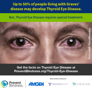 Up to 50% of people living with Graves' disease may develop Thyroid Eye Disease, but TED requires special treatment.