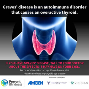 Graves' disease is an autoimmune disorder that causes an overactive thyroid.