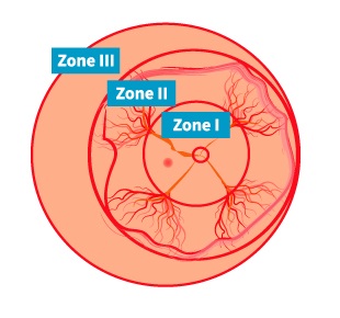 ROP Zones in the left eye