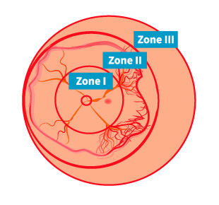 ROP zones in the right eye