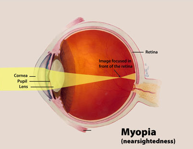 myopia (nearsightedness) - how the lens focuses light on the retina.