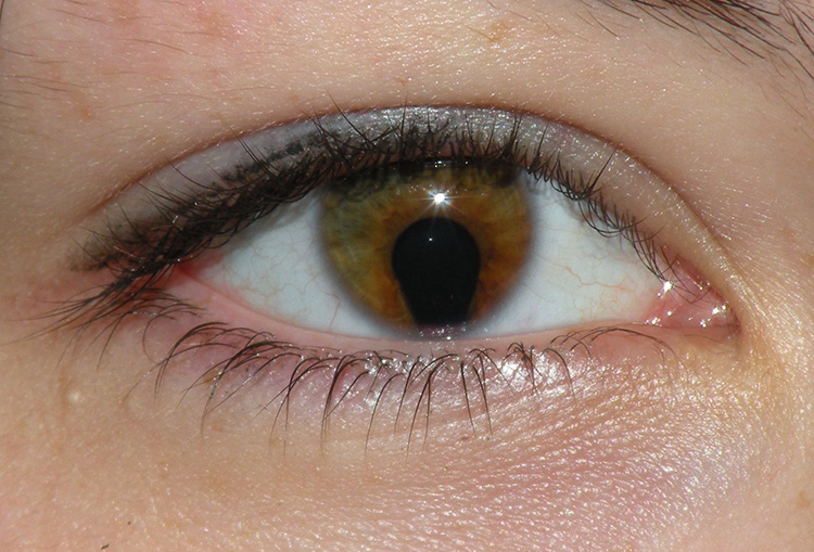 Close up of a human eye with a coloboma of the iris and an irregularly shaped pupil.