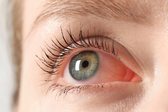 Prevent Blindness Declares Fifth Annual Inflammatory Eye Disease (IED) Week