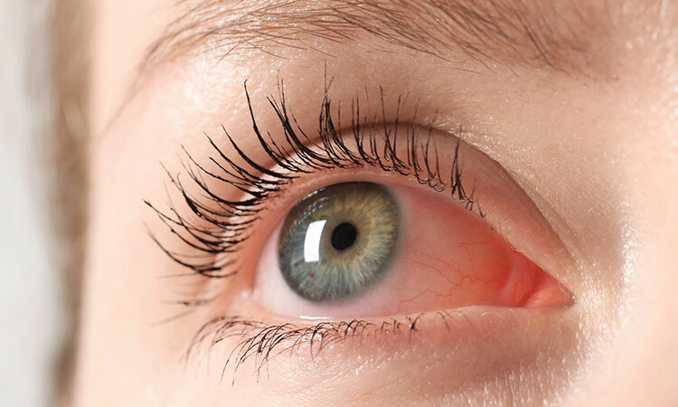 Prevent Blindness Declares Fifth Annual Inflammatory Eye Disease (IED) Week
