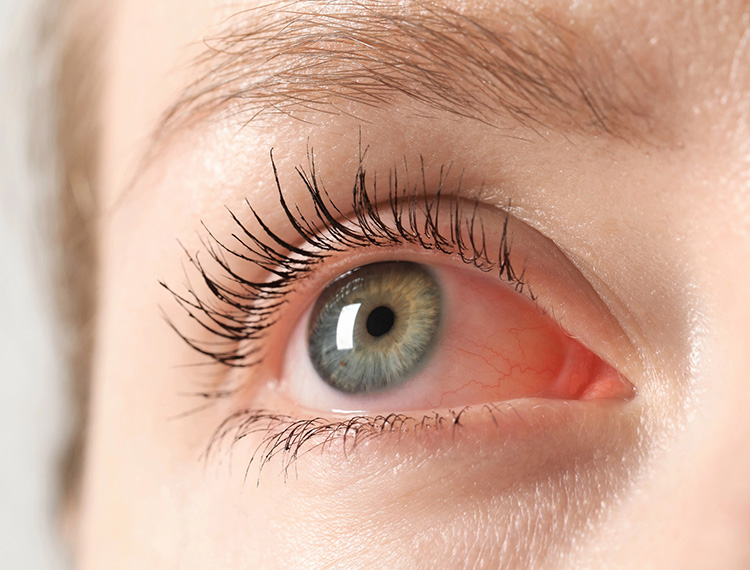 eye inflammation