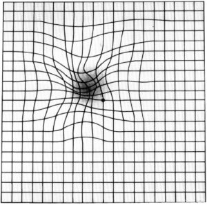 An Amsler Grid may appear distored to individuals with MacTel