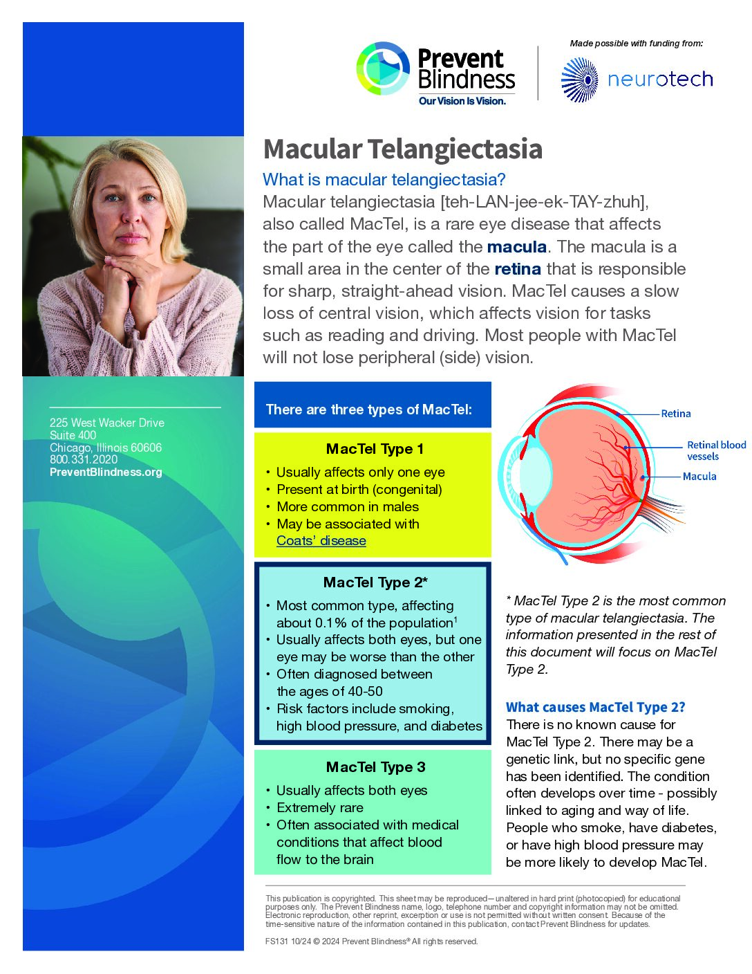 Macular Telangiectasia (MacTel)