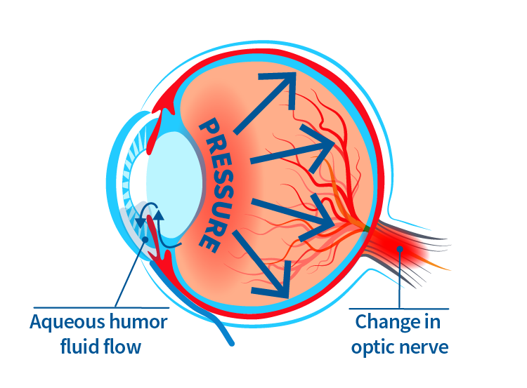 an eye diagram showing the link between aqueous humor fluid flow, pressure inside the eye, and changes to the optic nerve for patients with glaucoma.