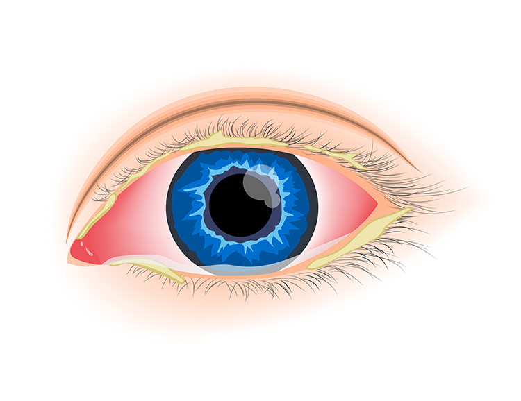 Bacterial Conjunctivitis (Pink Eye)