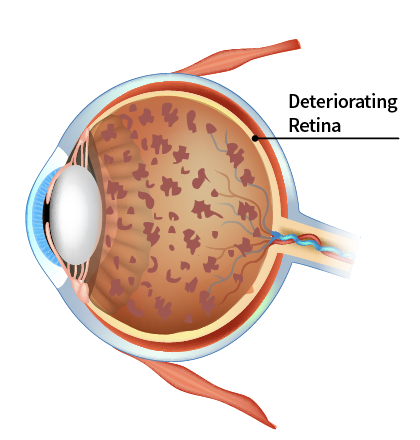 an eye with retinitis pigmentosa, showing a deteriorating retina