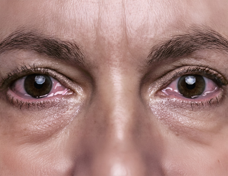 thyroid eye disease symptom - red eyes/bulging eyes