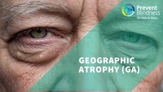 Geographic Atrophy