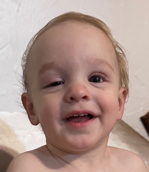 an infant with a droopy eyelid