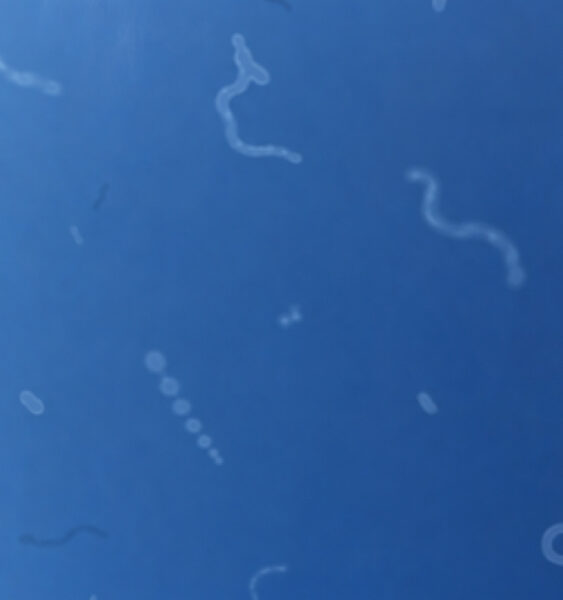 an illustration of floaters in the eye