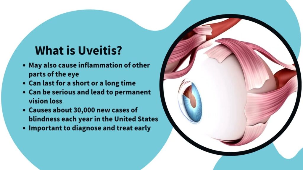 Uveitis Explained: Causes, Symptoms, Treatment & How to Prevent Vision Loss